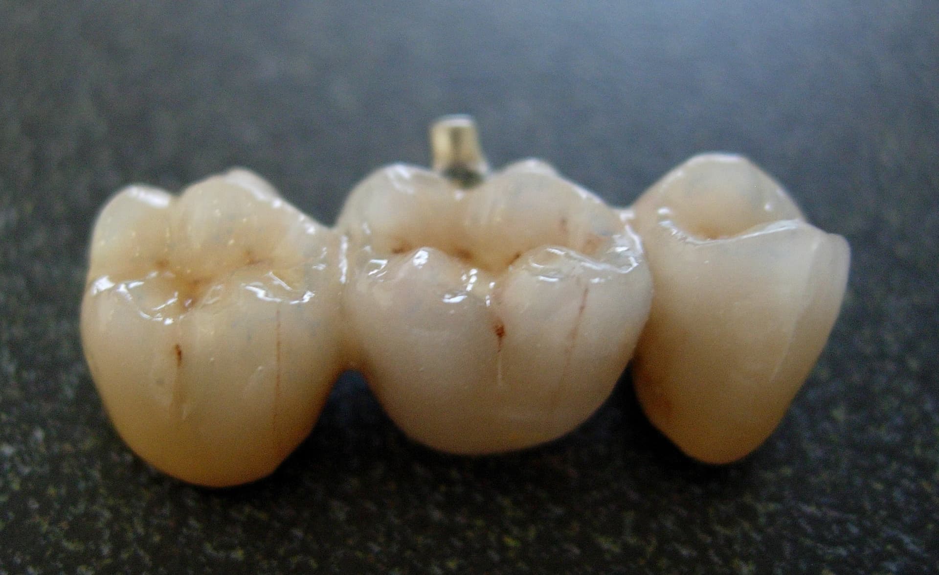 Three-unit porcelain fused to metal dental bridge