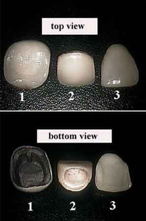 Comparison between dental crowns and porcelain veneer -- key components of aesthetic dental care