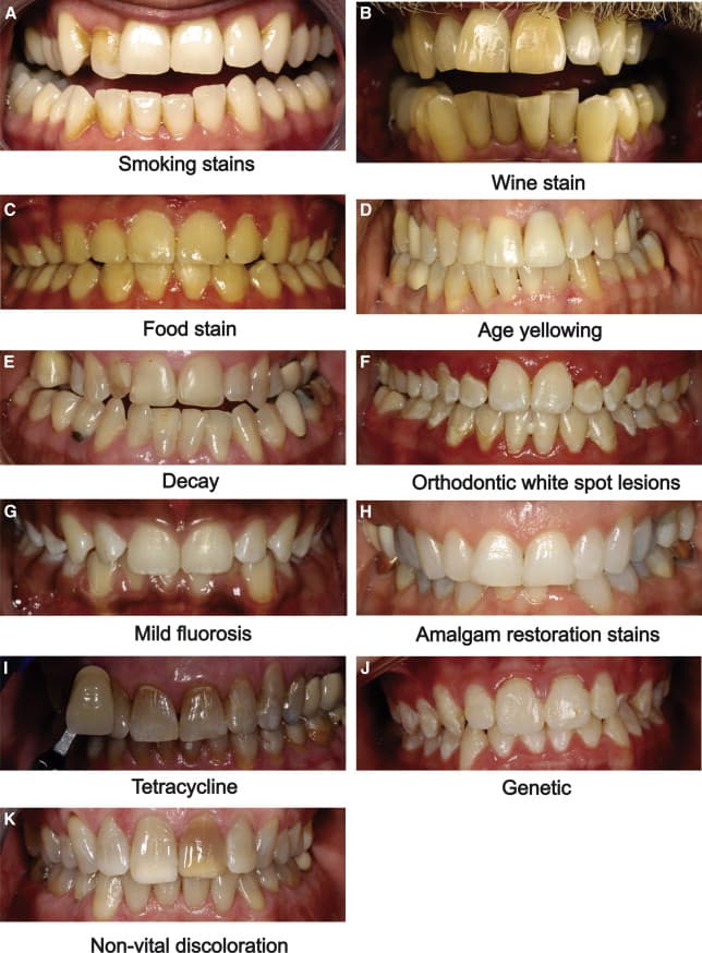 Examples of tooth staining types that smile makeovers can address